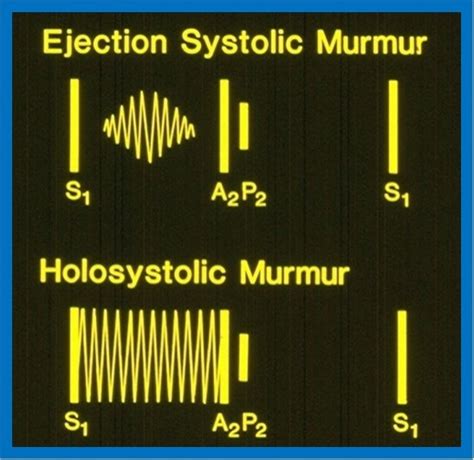 Artist’s rendition of auscultatory findings of systolic murmurs ...