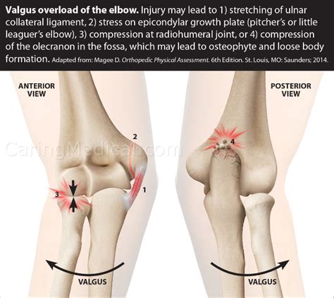 Elbow Bone Spur Treatment - Pregnancy Informations