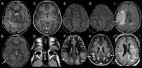 MOG-IgG-associated disorders (MOGAD) and tumefactive demyelination in ...