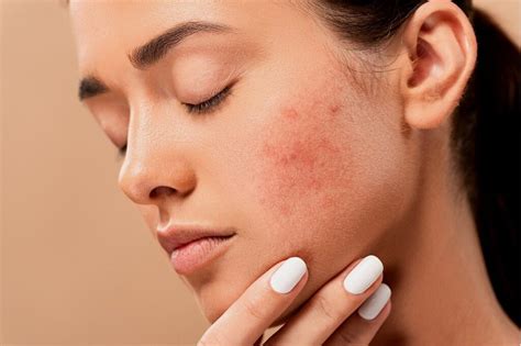 Heal Acne In Just 4 Hours With Pimple Patches - Woman Reigns