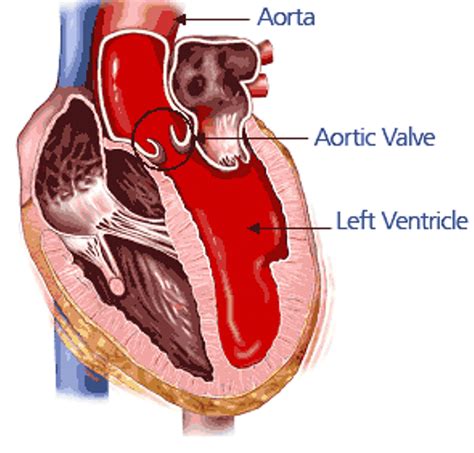 Aortic Stenosis - Perfusion.com