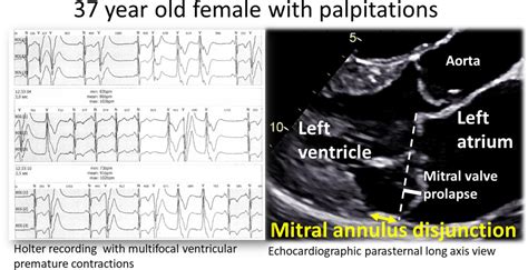 Improving the imaging diagnosis of mitral annular disjunction | Heart