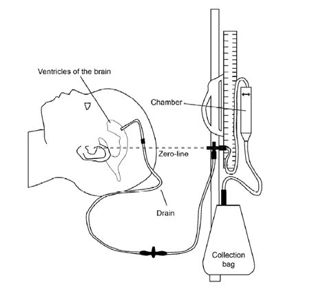 External ventricular drain | Children's Health Queensland