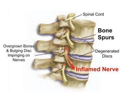 symptoms of lumbar osteophytes Archives - Spinal Back Rack