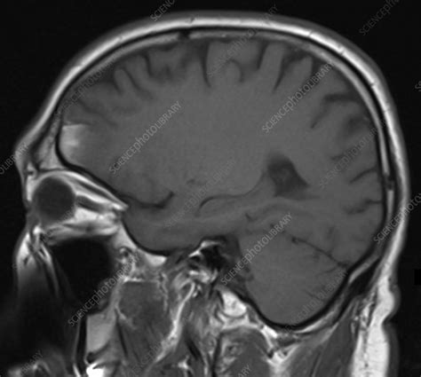 Brain Contusion, MRI - Stock Image - C039/3524 - Science Photo Library