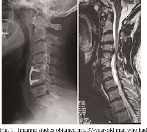 Figure 2 from Complications of revision spinal surgery. | Semantic Scholar