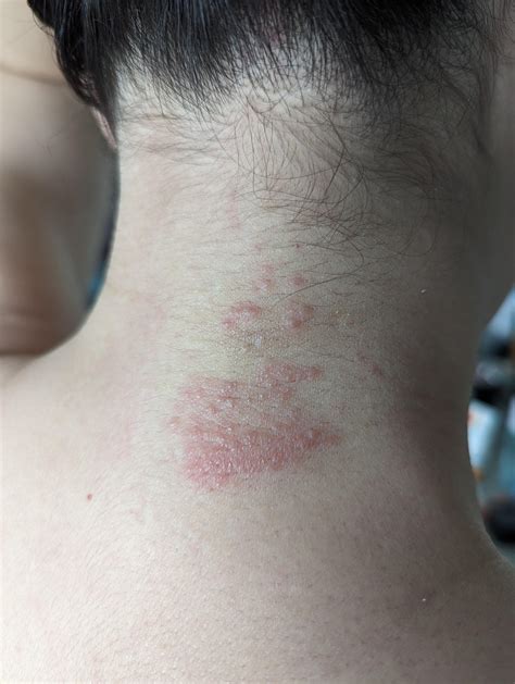 Woman's itchy neck rash help. : r/DermatologyQuestions