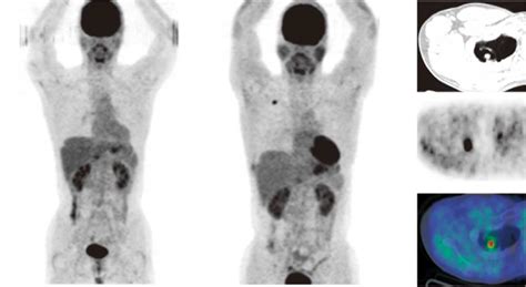 A case of primary lung cancer lesion demonstrated by F-18 FDG positron emission tomography ...