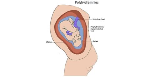 Polyhydramnios/ Hydramnios - New