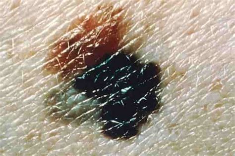 Black Spots on Skin, Dots, Patches, Dark, Tiny, Itchy, Pictures, Causes, Get Rid, Treatment ...