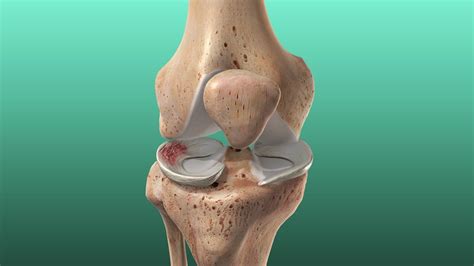 Meniscus Tear: Do I need surgery? | LaptrinhX / News