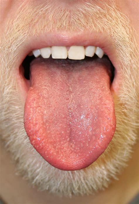 Bumps on the Tongue: What It Could Mean | Reader's Digest