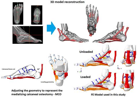 Mathematics | Free Full-Text | Biomechanical Effects of Medializing ...