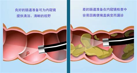 肠镜准备的清肠药那么难喝，怎么办？ - 微医（挂号网）