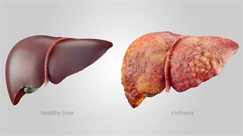 What Is Hepatitis D? Symptoms, Causes, Diagnosis, Treatment, and Prevention