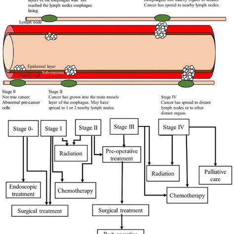 Treatment of oesophageal cancer at different stages (130). | Download Scientific Diagram