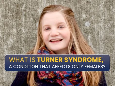 Turner Syndrome Causes Symptoms Complications And Tre - vrogue.co