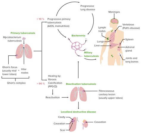 Tuberculosis | Concise Medical Knowledge