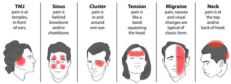 Is Pain behind left Eye associated with a Migraine? | IrisTech