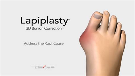 LAPIPLASTY® System | Treace Medical Concepts, Inc.How the Lapiplasty® Procedure Works | Treace ...