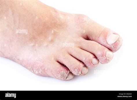 Psoriasis Foot Stock Photos & Psoriasis Foot Stock Images - Alamy