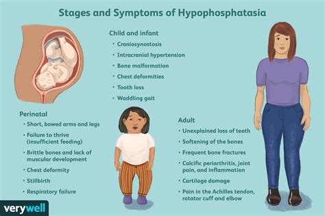 Hypophosphatasia: Symptoms, Causes, Treatment, and More