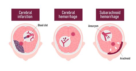 Subarachnoid hemorrhage