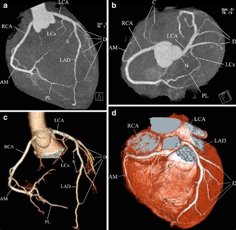 Coronary artery anomalies and clinically important anatomy in patients ...