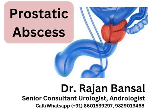 Prostatic Abscess: Causes, Symptoms, Diagnosis, and Treatment