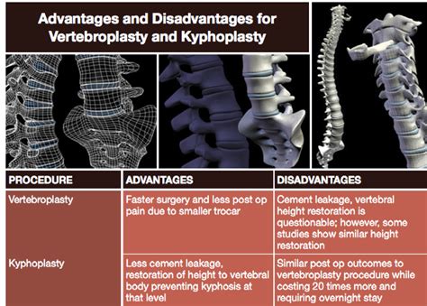 kyphoplasty vs vertebroplasty - Google Search | Medical advice, Interventional radiology ...