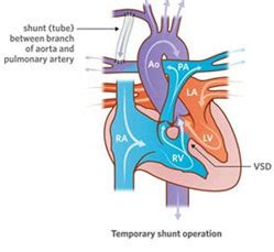 BT Shunt Surgery Cost India| Palliative Pediatric Cardiac Surgery India