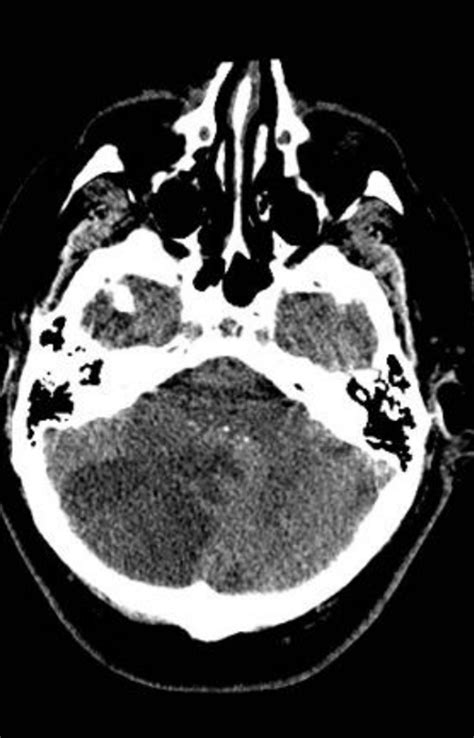 emDOCs.net – Emergency Medicine EducationEM@3AM: Cerebellar Stroke - emDOCs.net - Emergency ...