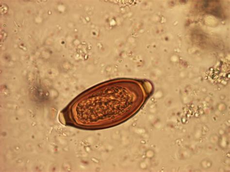 Blastocystis Parasite Blog: Trichuris