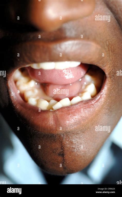 Diseases Eumycetoma Stock Photo - Alamy