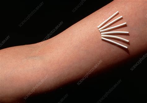 Norplant contraceptive implants - Stock Image - M860/0101 - Science Photo Library