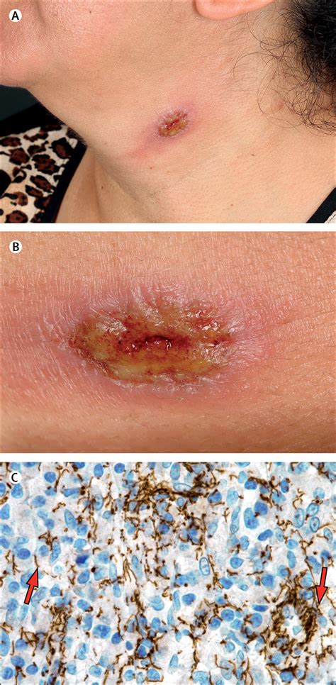 Liaison leads to solitary syphilitic chancre on the neck - The Lancet