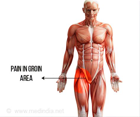 Show Me The Groin Area - Pulled Groin Muscle Symptoms Treatment Ati Physical Therapy : Their are ...