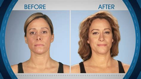 Ski-Lift Nose from Botched Patients Before and After: Shocking Transformations! | E! News