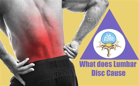 Suffering with Lumbar Disc problem: Know all about Lumbar discs here