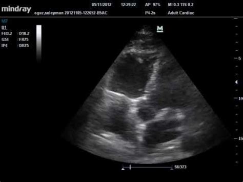 Cardiac Mcconnell Sign Acute Submassive Pulmonary Embolism