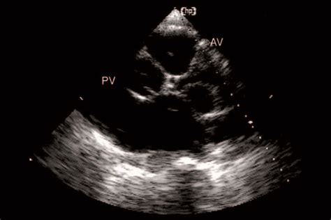 Echocardia - Wiki