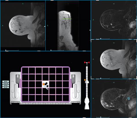 Who Needs a 3D Mammogram and Benefits of 3D Breast MRI’s — Oakland MRI