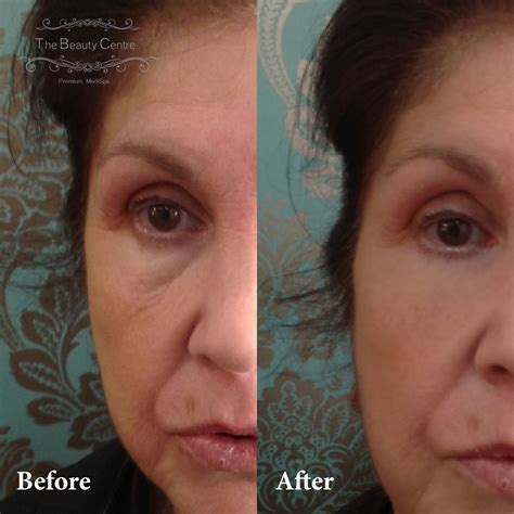 See for yourself how #InstantlyAgeless completely eradicates lines ...