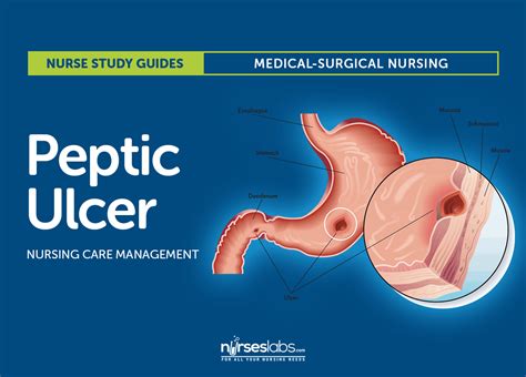 Peptic Ulcer