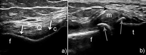 Ultrasound of the knee in Rheumatology: Pitfalls, what is new? | MJR - Mediterranean Journal of ...