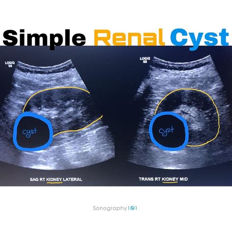 Kidney Size Chart For Renal Cyst