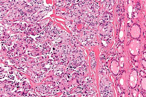 Medullary thyroid cancer pathophysiology - wikidoc