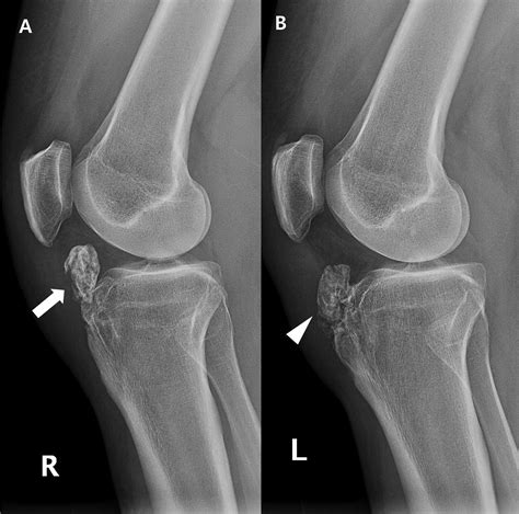 Cureus | Intra-articular Large Ossicle Associated to Osgood-Schlatter Disease