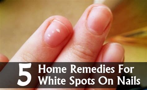 5 Amazing Home Remedies For White Spots On Nails | Search Herbal & Home Remedy