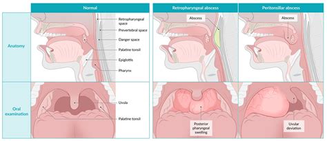 Retropharyngeal Abscess Drainage